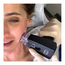 Morpheus8 Treatment-  Face + Neck OR Knees OR Upper Arms